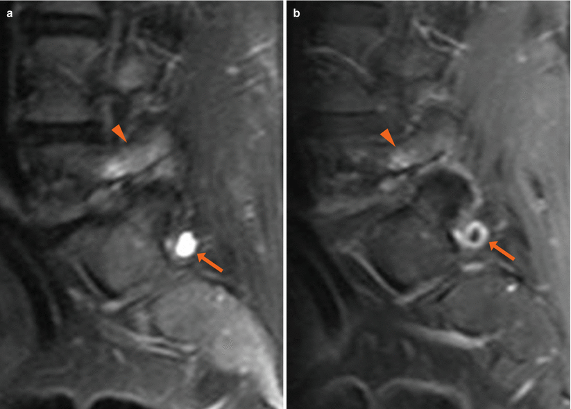 Facet Joint Osteoarthritis Radiology Key