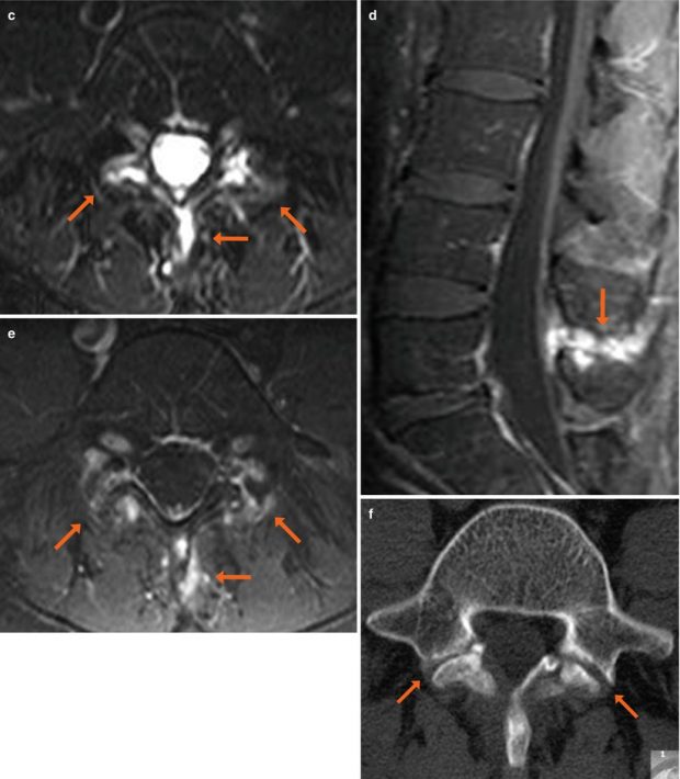 Facet Joint Effusion Radiology Key