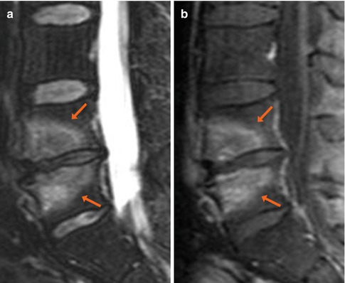 Osteochondrosis | Radiology Key