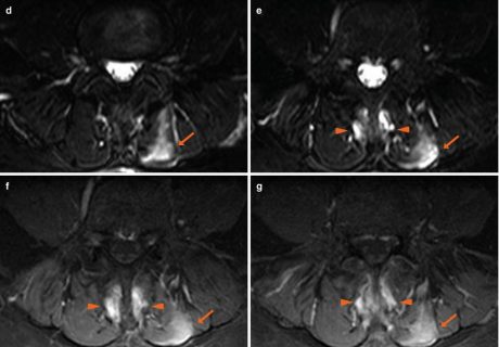 Facet Joint Effusion | Radiology Key