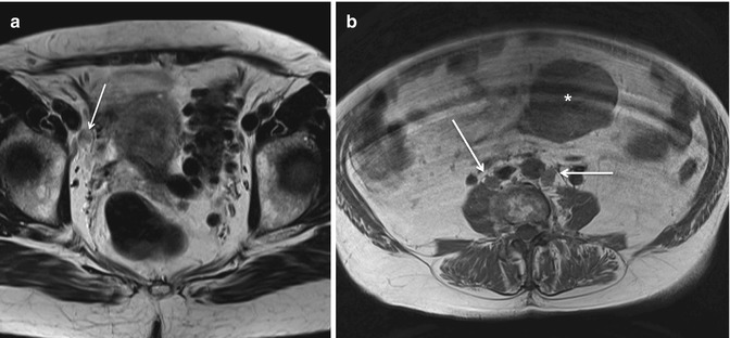 MRI Of Endometrial Carcinoma | Radiology Key