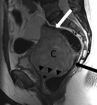 Uterine Cervix | Radiology Key