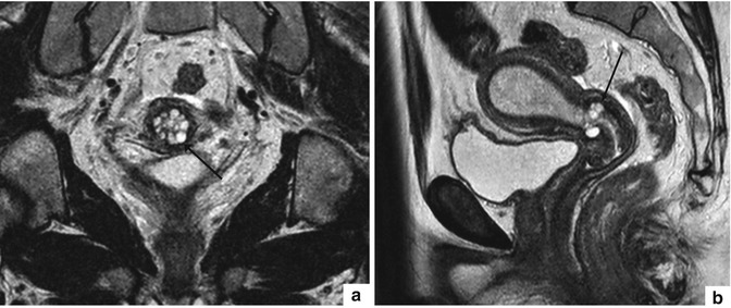 Cervical Uterus