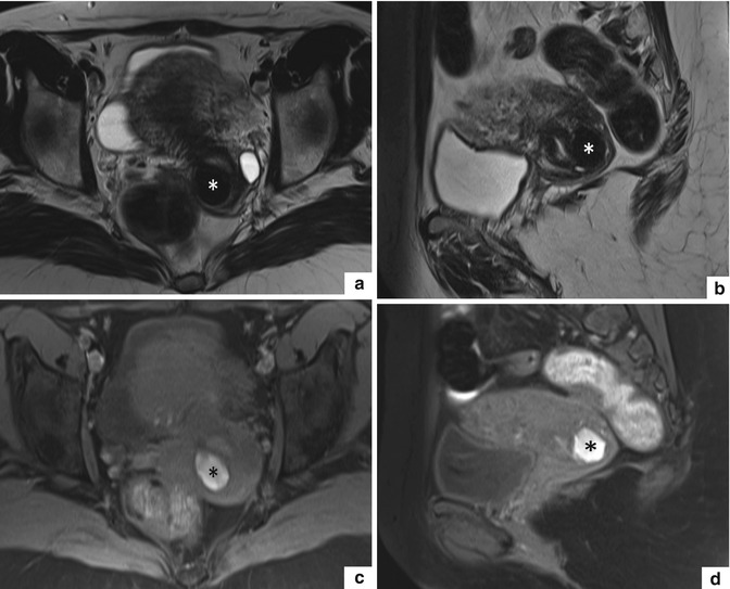 Uterine Cervix Radiology Key 