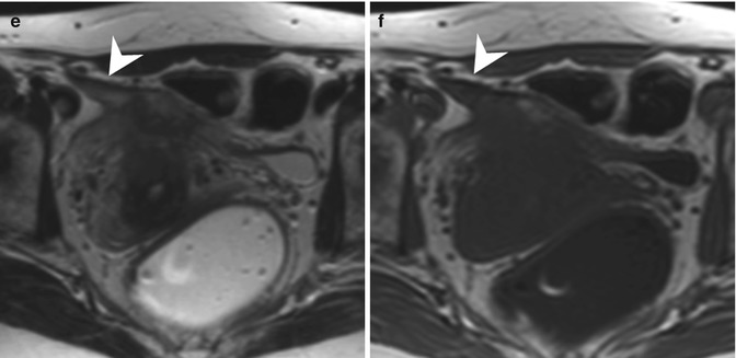 Endometriosis | Radiology Key