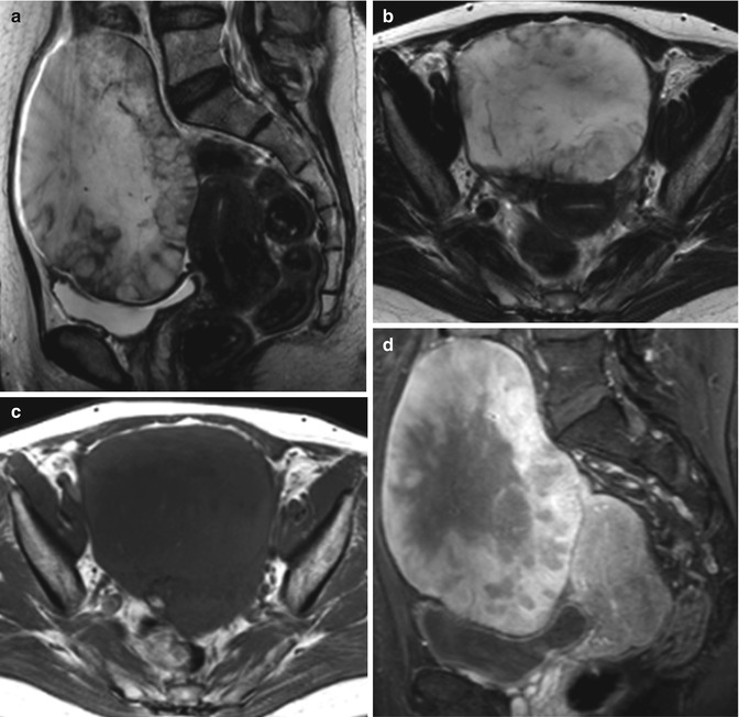 Neoplasms Of The Ovary Radiology Key