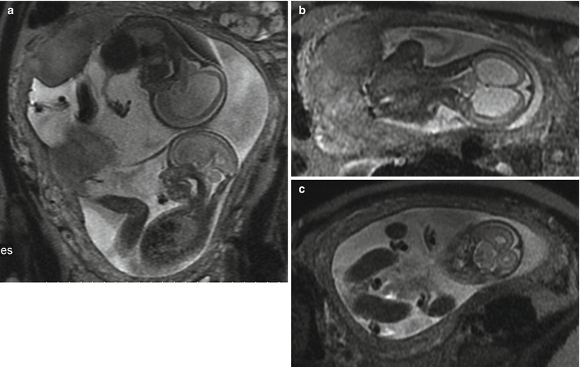 Mr Imaging Of Multiple Gestations Radiology Key