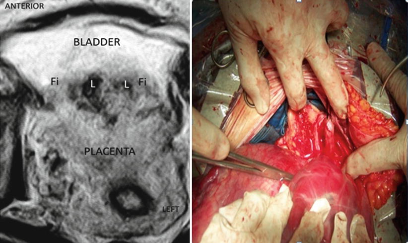 placenta posterioara gradul 2
