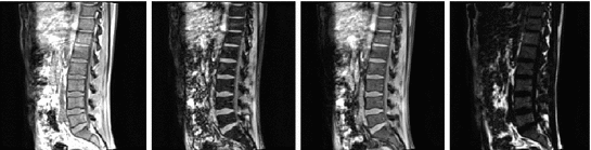 3D Lumbar Intervertebral Disc Segmentation From MRI Data Sets ...