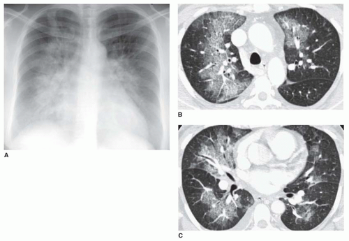 Ct Chest Pulmonary Edema