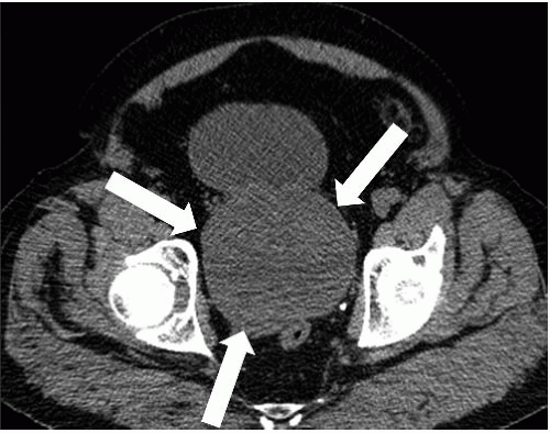 Benign Prostatic Hypertrophy Ultrasound 7076