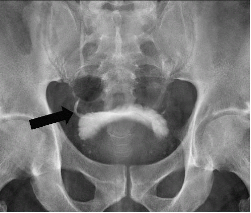 enlarged prostate x ray