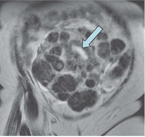 Diseases Of The Uterus Radiology Key