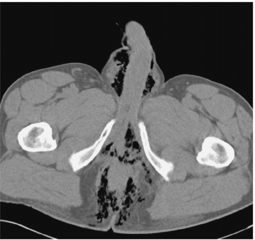 Scrotum And Contents Radiology Key