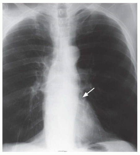 aortic stenosis x ray
