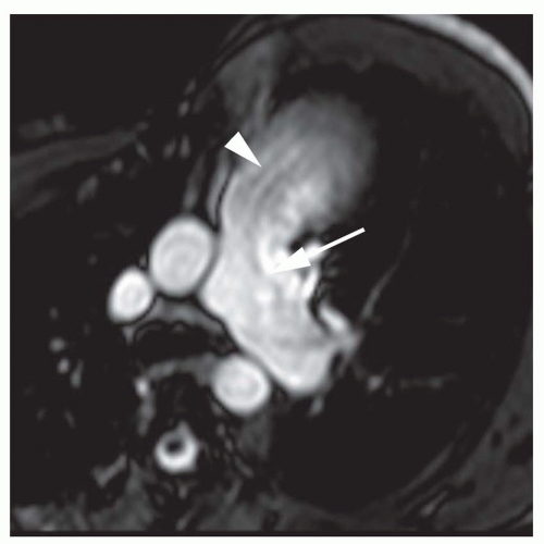 Valvular Heart Disease | Radiology Key