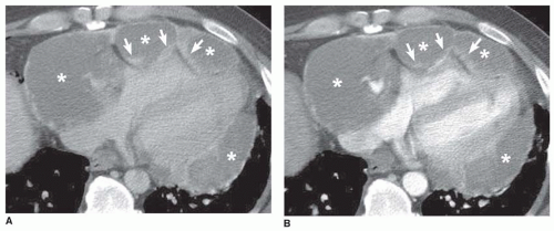 Pericardial Diseases | Radiology Key