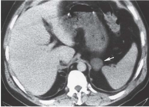 The Adrenal Gland Radiology Key 1144