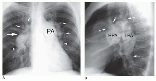 The Pulmonary Hila Radiology Key The Pulmonary Hila Radiology Key