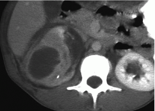 Renal Inflammatory Disease Radiology Key