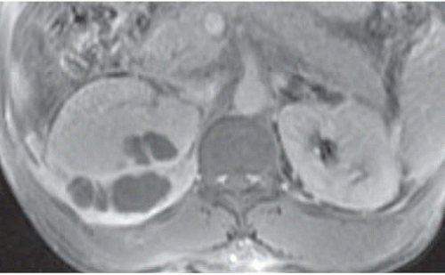 Renal Inflammatory Disease Radiology Key