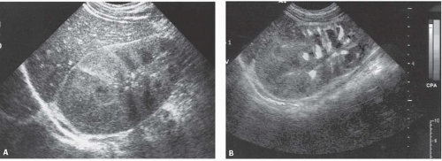 glomerulonephritis ultrasound