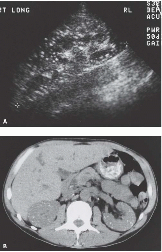 Renal Inflammatory Disease Radiology Key