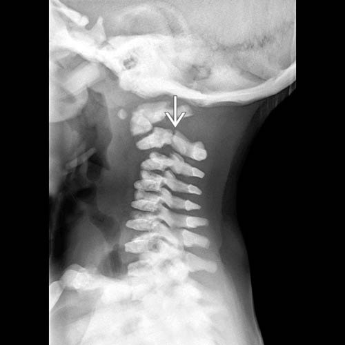 Osteopetrosis | Radiology Key
