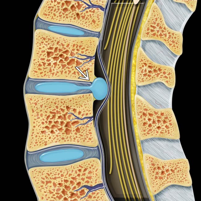 degenerative disc disease research paper