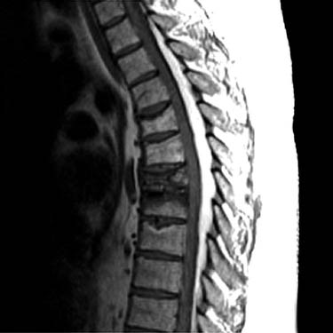 Epidural Lipomatosis | Radiology Key