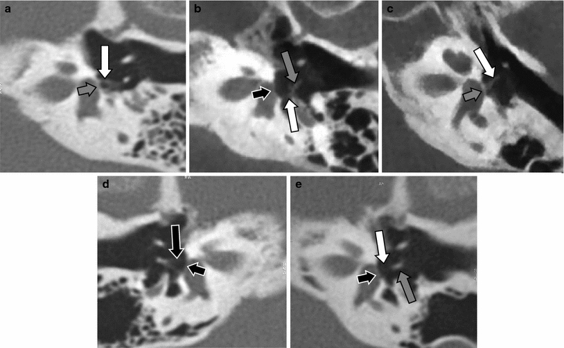 Stapes, Radiology Reference Article