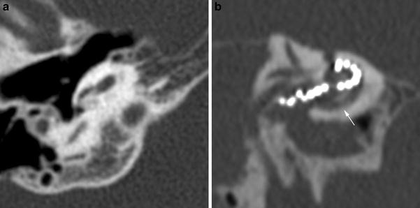 Of Cochlear Implants | Radiology Key