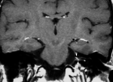 Temporal Bone Imaging Radiology Key