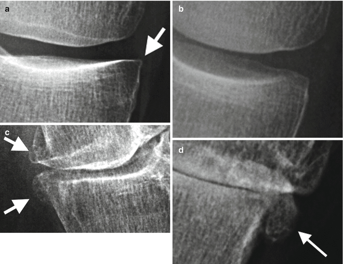 Large Anterior Osteophytes