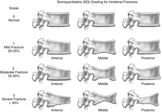 Semiquantitative (SQ) visual grading scheme for vertebral fractures.