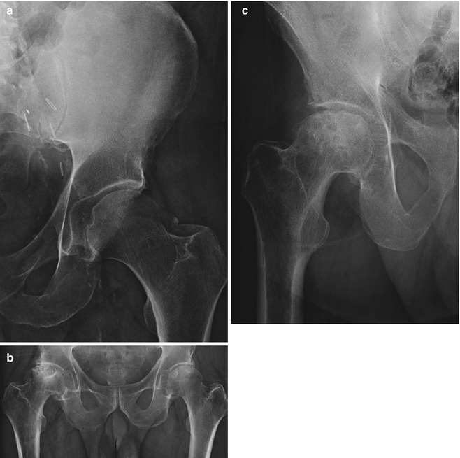 Osteonecrosis Of Hip