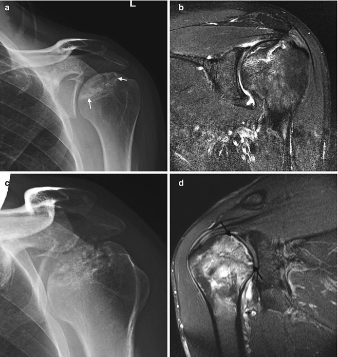 Osteonecrosis | Radiology Key