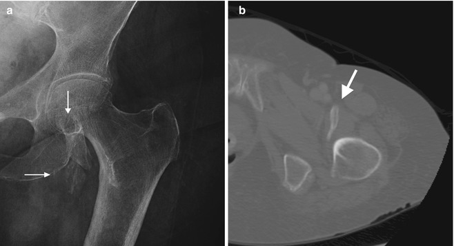 Soft Tissue Calcifications Radiology Key 0947