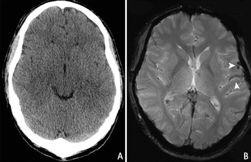 Diffusion Tensor Imaging in Traumatic Brain Injury | Radiology Key