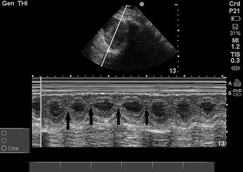 Pleural Ultrasound | Radiology Key