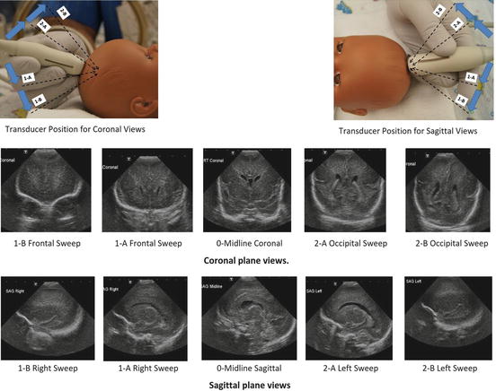 Ultrasound In The Neonatal Intensive Care Unit Radiology Key