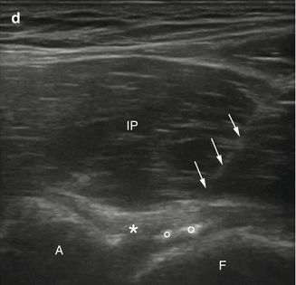 Hip Intra-articular Injections | Radiology Key