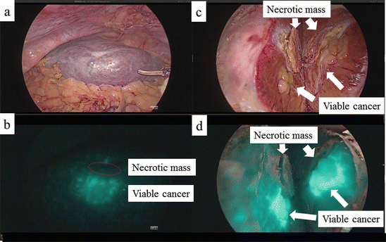 Laparoscopic Intraoperative Identification of Liver Tumors by ...