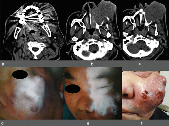 ICG Fluorescent Image-Guided Surgery In Head And Neck Cancer ...