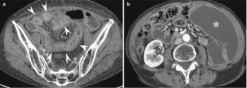 Ischemic Bowel Disease And Vasculitis Radiology Key