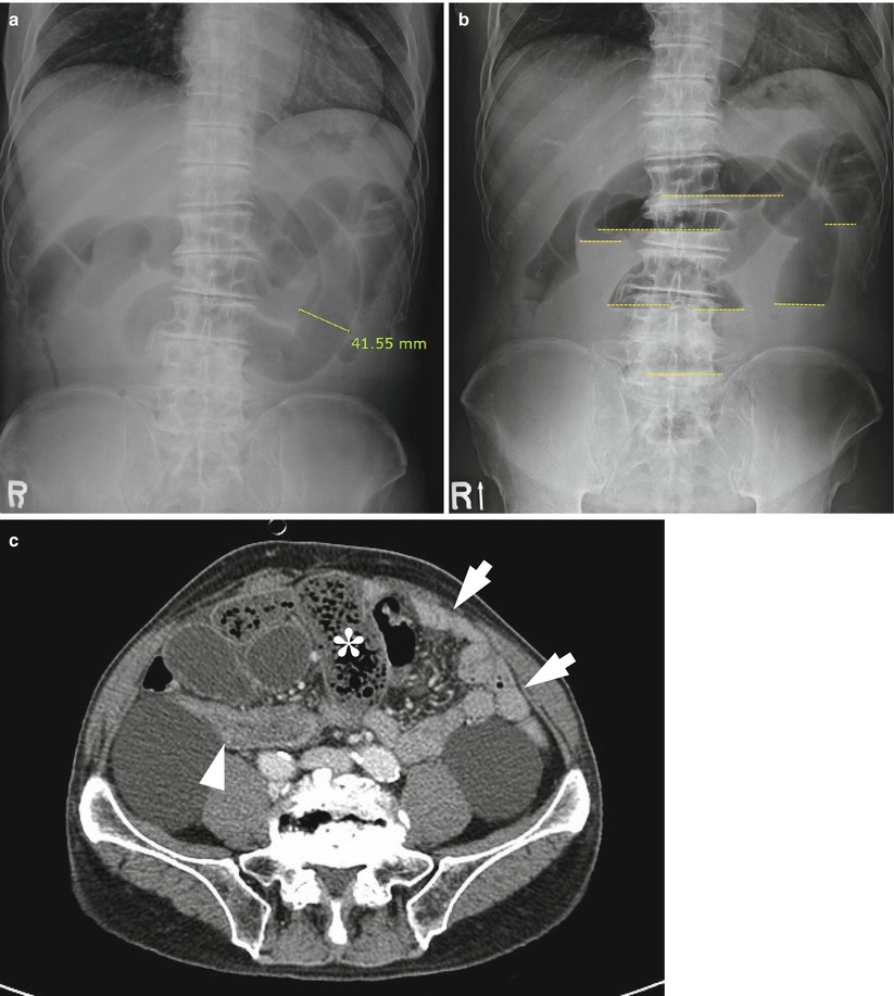 Small Bowel Obstruction Radiology Key 