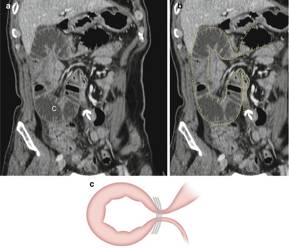 Small Bowel Obstruction Radiology Key