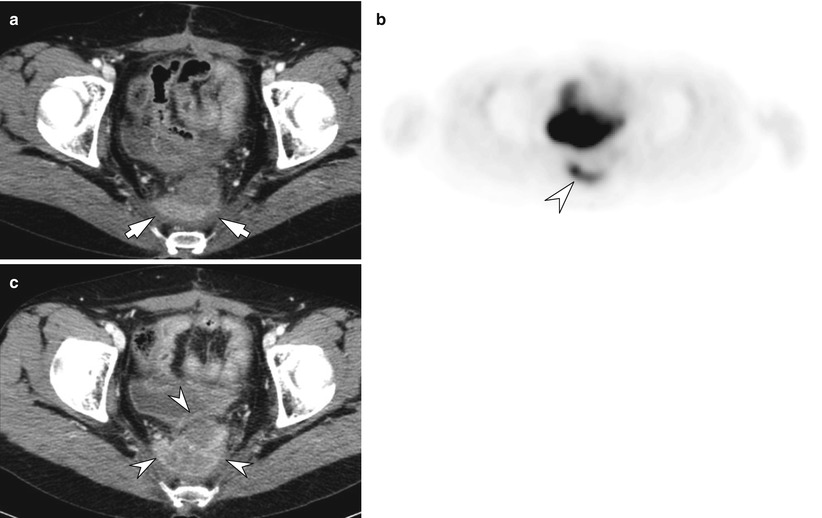 Postoperative Change and Complications of the Colon | Radiology Key