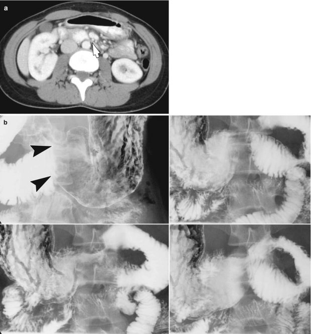 Benign and Malignant Tumors of the Esophagus | Radiology Key