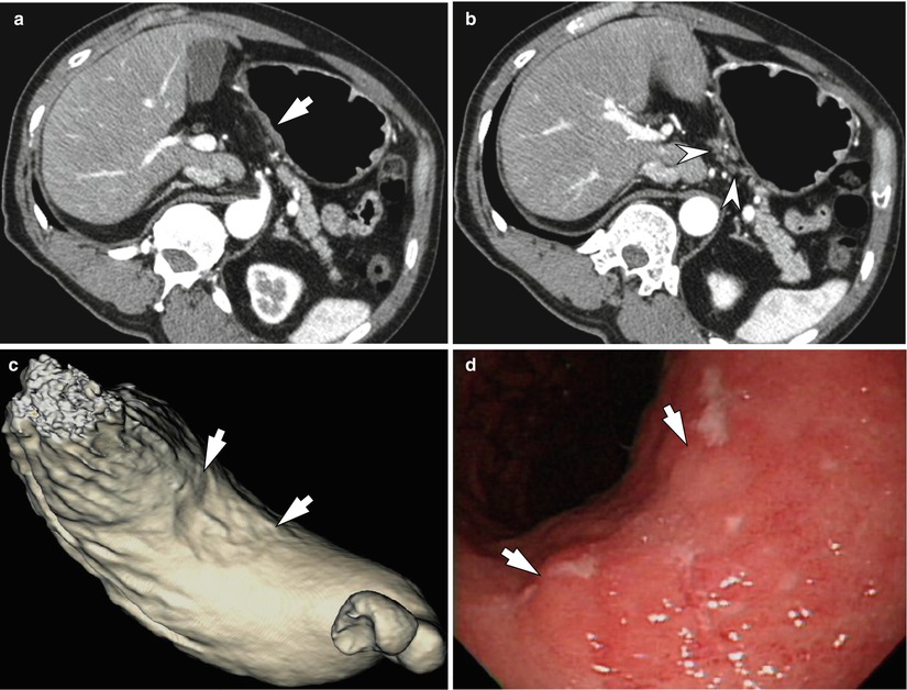 Lymphoma And Metastasis Of The Stomach Radiology Key